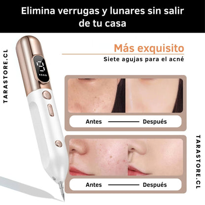 Plasmapen Removedor Verrugas Y Lunar